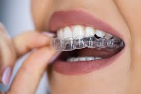 Invisalign Beispielbild